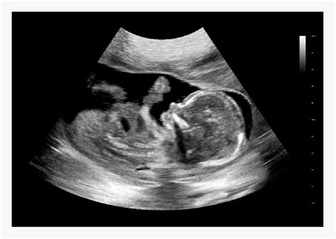 Free Fake Ultrasound